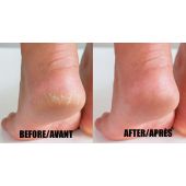 Dermaline™ PediGuard Callus remover